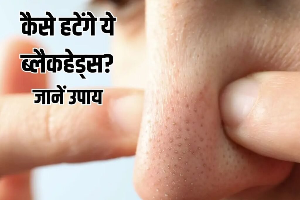 Blackheads Treatment: स्किन के डॉक्टर से जानें, ब्लैकहेड्स- वाइटहेड्स के बनने का कारण और इसका इलाज