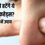 Blackheads Treatment: स्किन के डॉक्टर से जानें, ब्लैकहेड्स- वाइटहेड्स के बनने का कारण और इसका इलाज