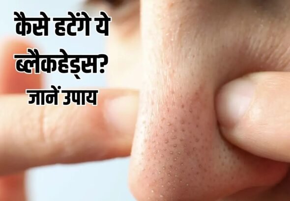 Blackheads Treatment: स्किन के डॉक्टर से जानें, ब्लैकहेड्स- वाइटहेड्स के बनने का कारण और इसका इलाज